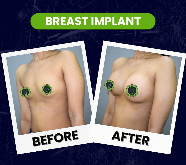 breast implant plastic surgery